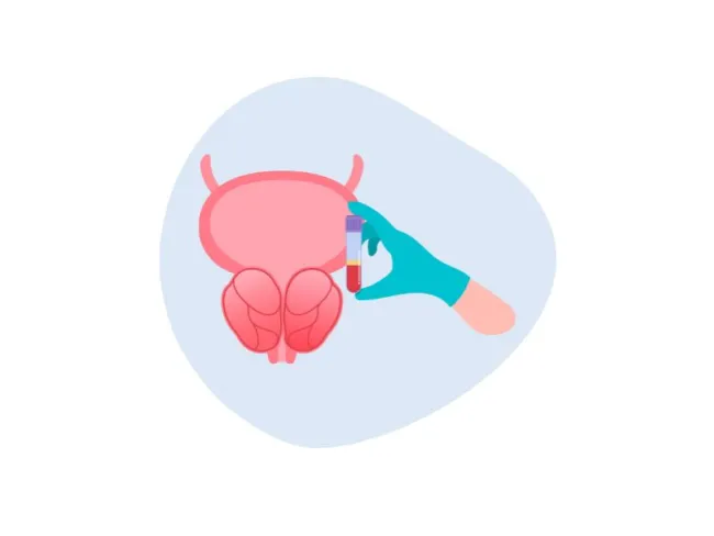 Adenom de prostată: Cauze & simptome - Tratament pentru prostata marită