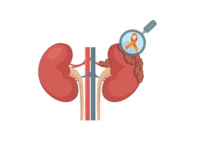 Cancerul renal: Cauze, Simptome & Analize pentru Diagnostic