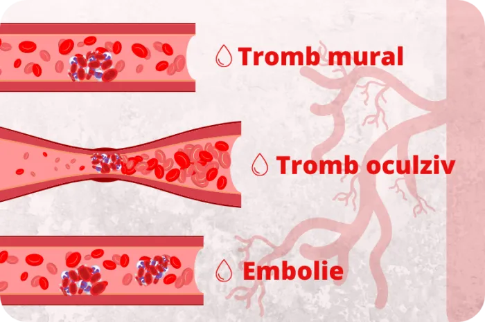 tromboza, trombofilie