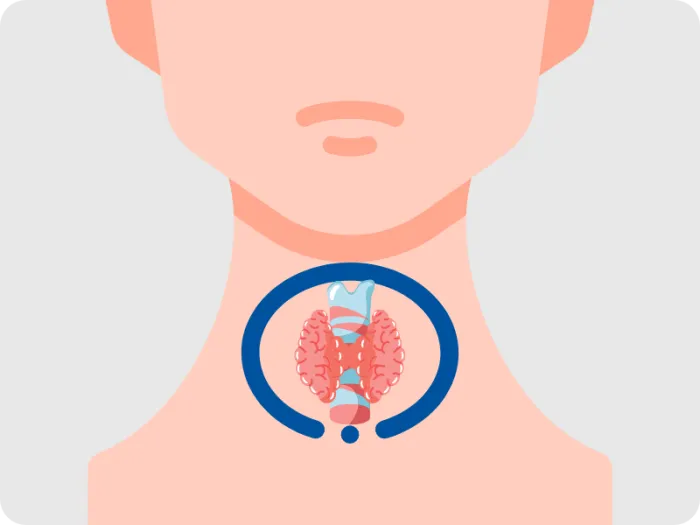cancer tiroidian, cancerul tiroidian, iodura de potasiu, noduli tiroidieni, tumora maligna
