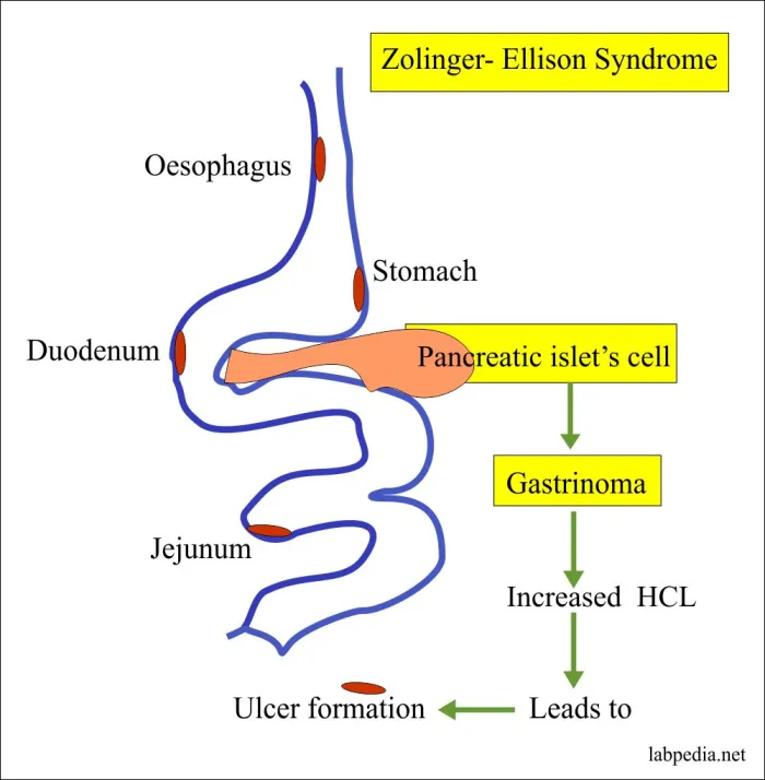 sidrom zollinger ellison, Zollinger Ellison, gastrina, pancreas