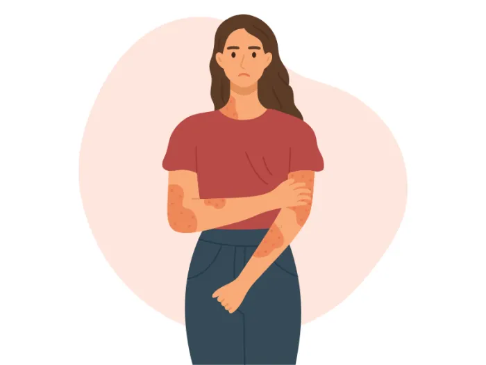 dermatita atopica, piele atopica, eczema, eczema piele, dermatita, eczeme, ce este dermatita