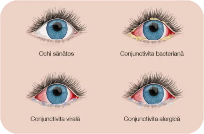 conjunctivita alergica, tratament conjunctivita alergica, alergie la ochi, mancarime ochi, alergie ochi