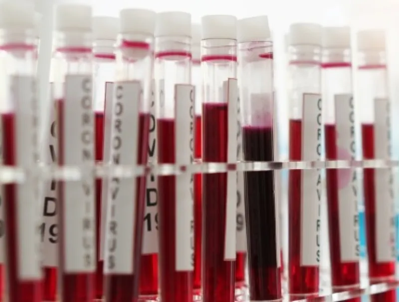 SARS-CoV-2: detecția anticorpilor IgG